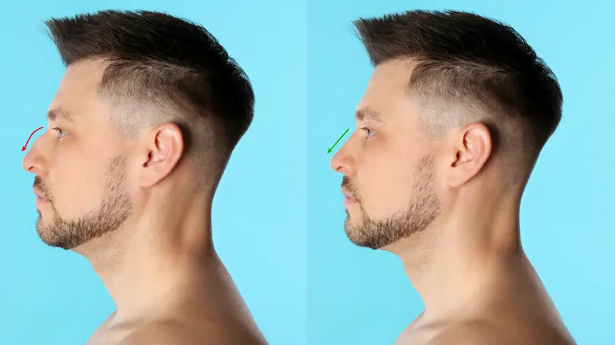 Dorsal Hump Reduction
