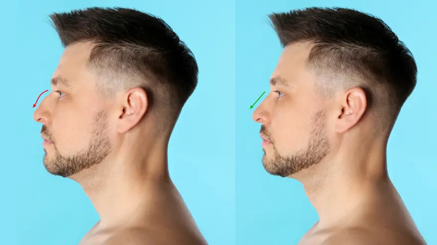 Dorsal Hump Reduction