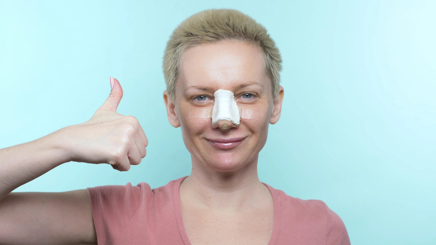 Bruising Normal After Rhinoplasty