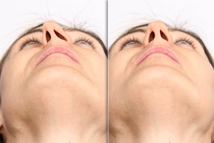 Enhancement of Nasal Aesthetics