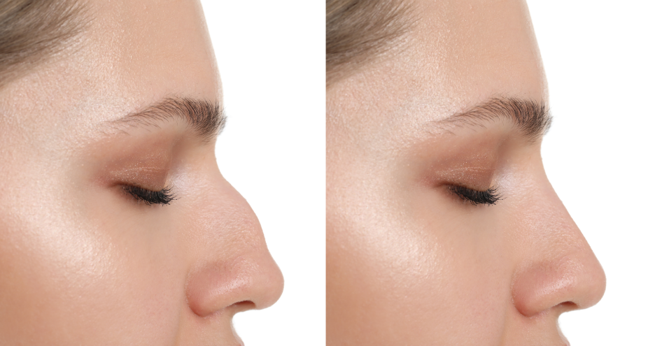 Before and After Photos