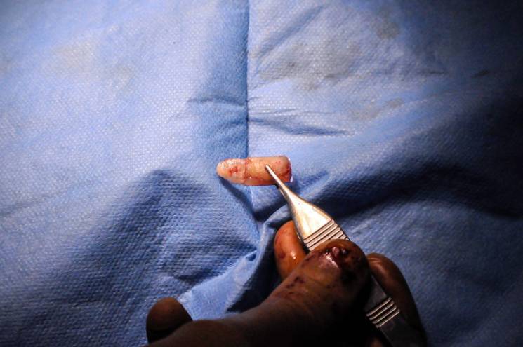 Rib Cartilage Grafting