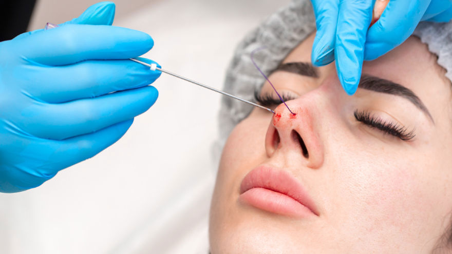 Liquid Rhinoplasty