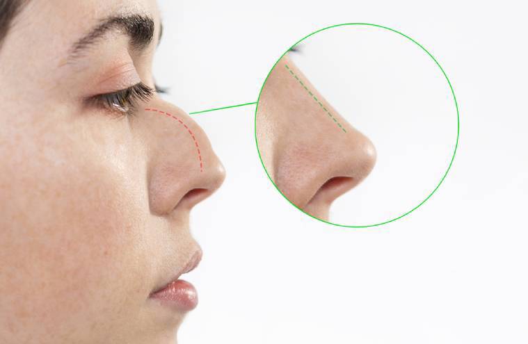 Crooked Nose