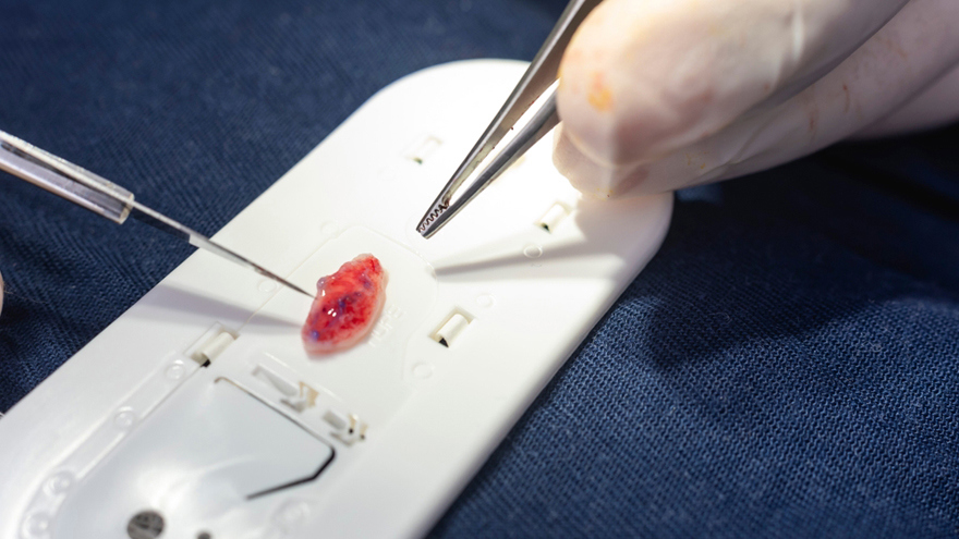 Cartilage Grafting