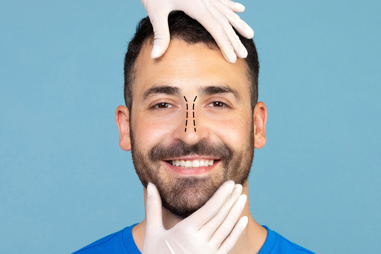 Rhinoplasty