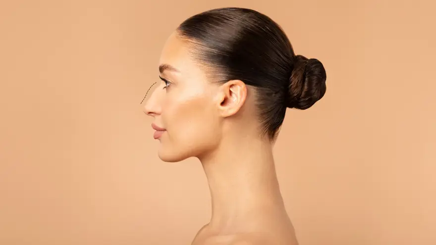 Hump Nose Treatment in Rhinoplasty