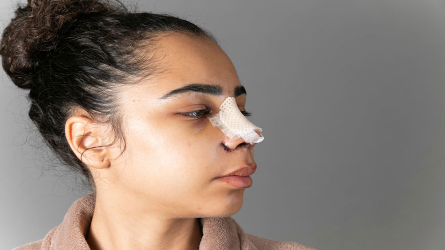 After Rhinoplasty