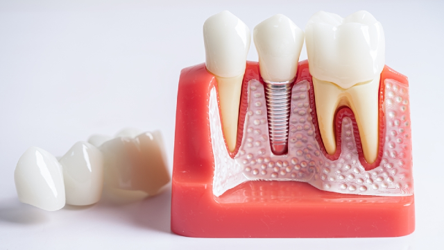 Same-Day Implants vs. Traditional Two-Stage Implants: Comparing Timelines and Candidacy