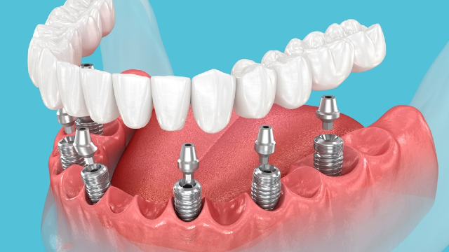 Removable Dentures vs. Implant-Supported Dentures: Comparing Comfort, Cost, and Care