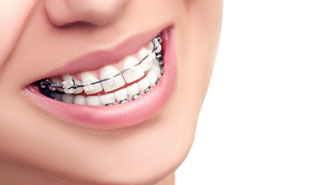 Speed Orthodontics vs. Rapid Partial Orthodontics: Which Accelerated Treatment Fits