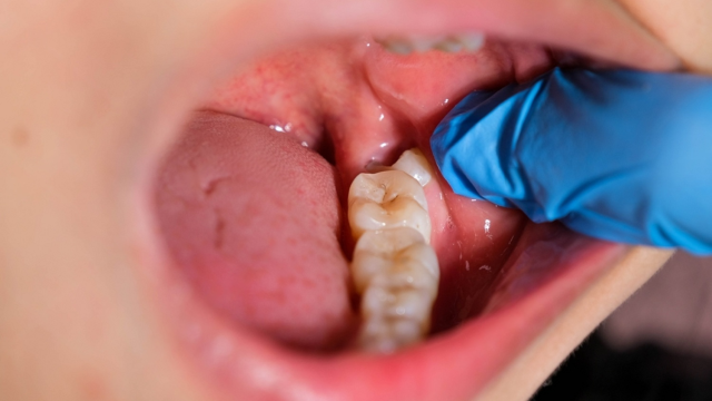 Impacted Wisdom Teeth: How Position and Root Anatomy Determine Extraction Difficulty