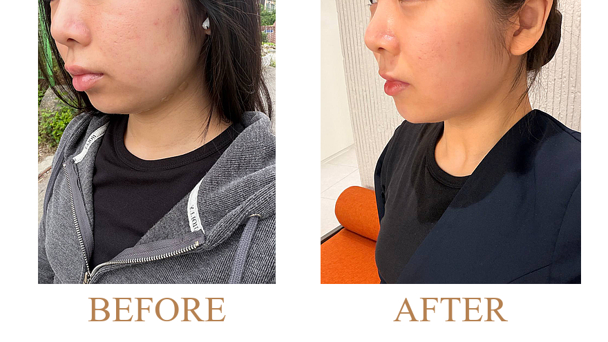 Pore Refinement & Inner-Dermal Hydration Barrier Recovery