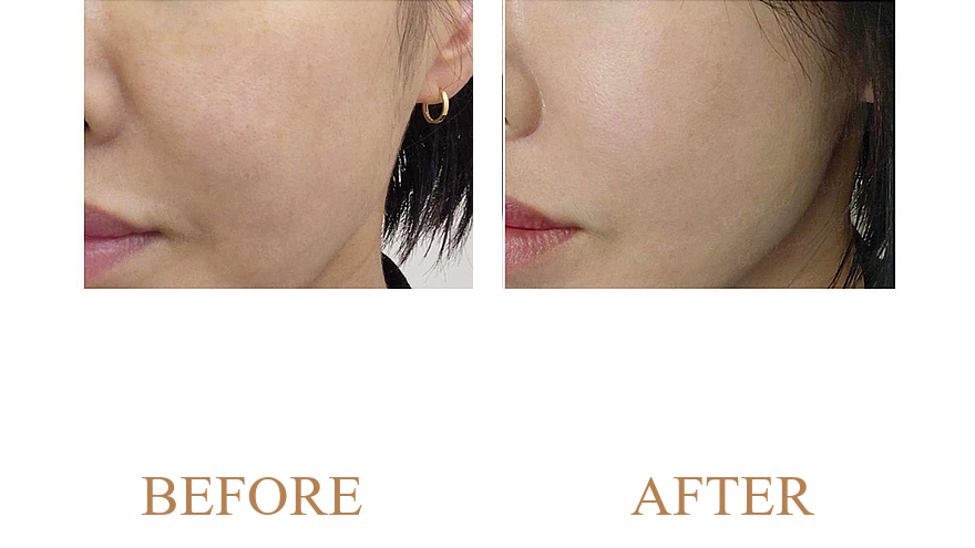 Stubborn Melasma, Sun Spots & Uneven Tone Brightening