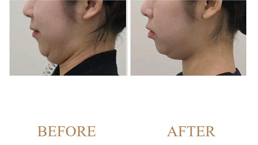 Balanced Mid-Face Volume & Natural Facial Harmony