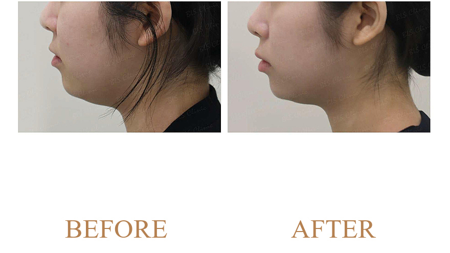 Cheek Elasticity Restoration & Fine Wrinkle Smoothing