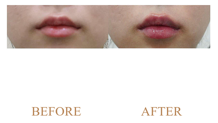 Post-Acne Erythema Calming & Atrophic Scar Texture Remodeling