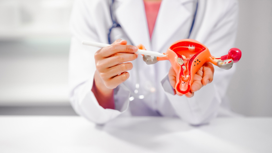 PCOS-Related Irregular Cycles: Comprehensive Care Plans