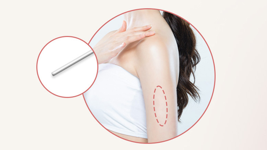 Subdermal Contraceptive Implant (Implanon)