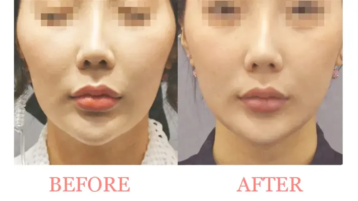 Lateral Cheek Filler