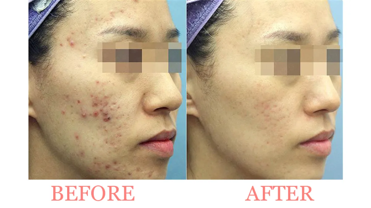 Acne Peel Treatment