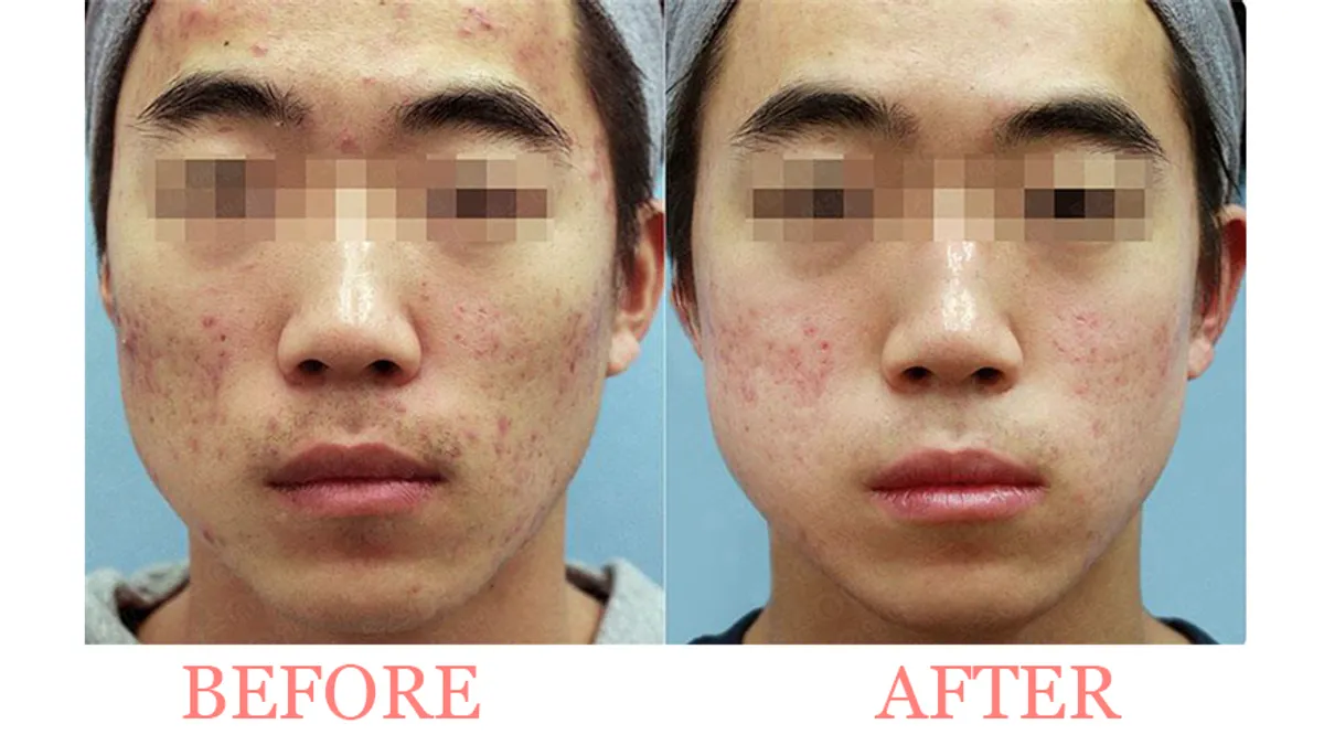 Acne Peel Treatment