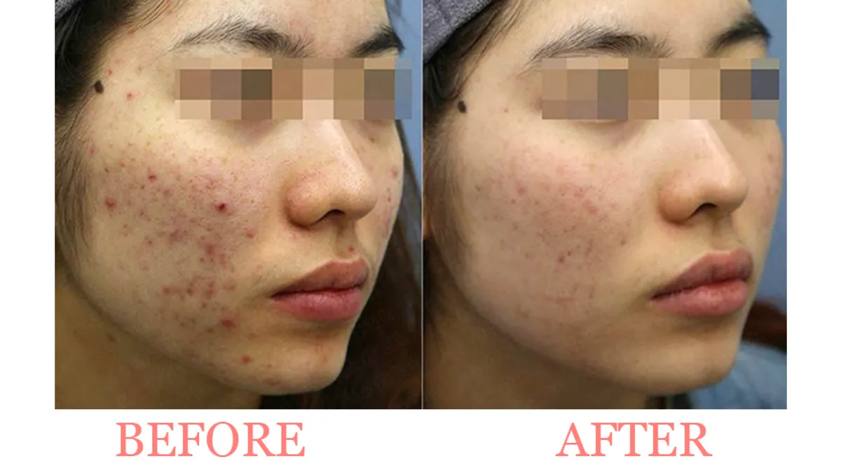 Acne Peel Treatment
