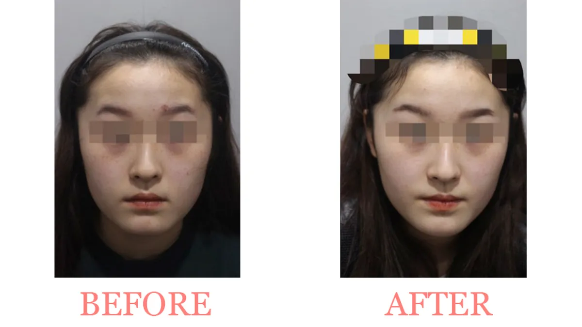Pigmentation treatment