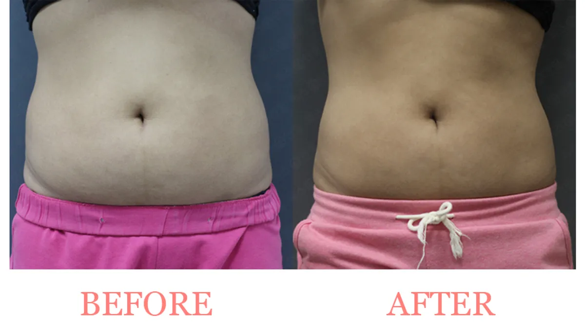 Body Contouring