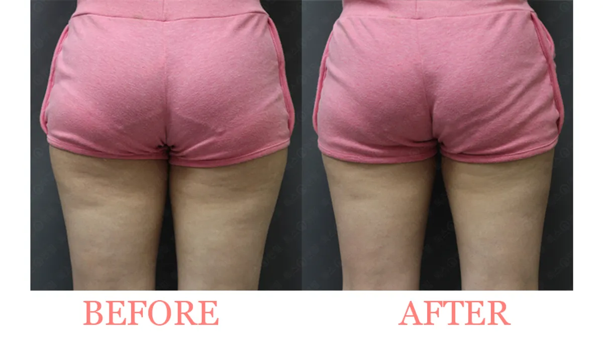 Body Contouring