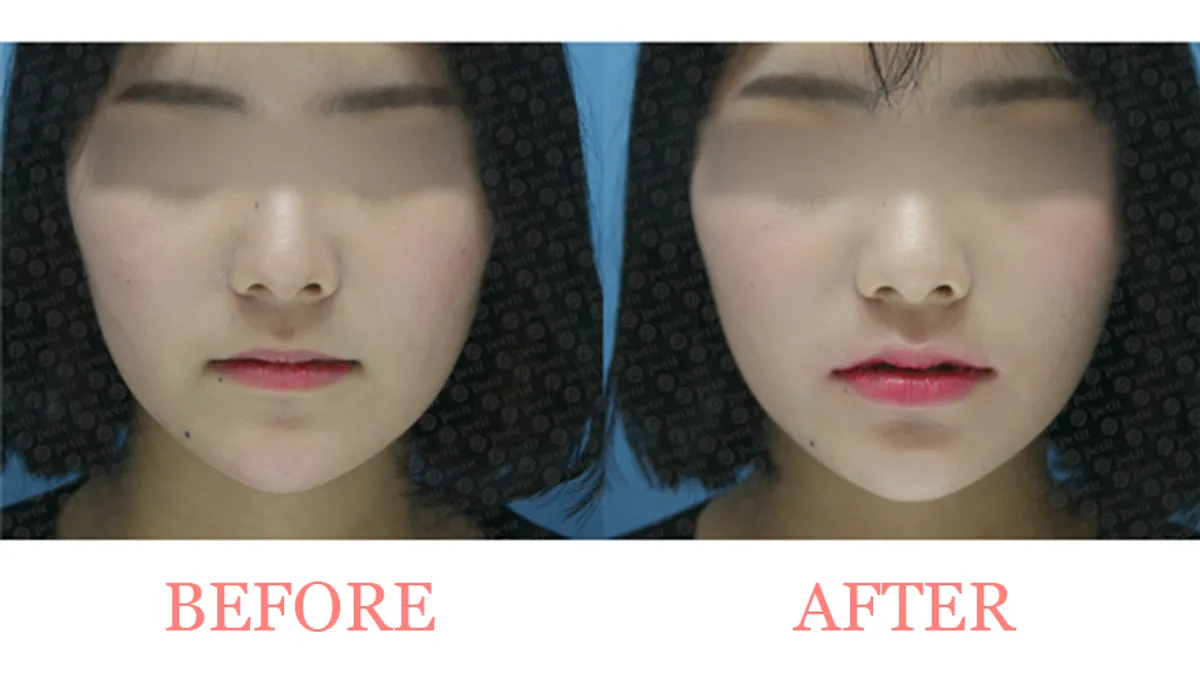 Lip Filler