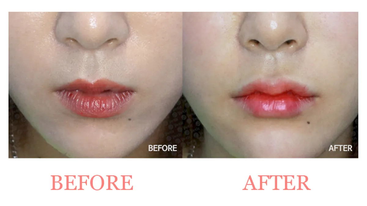 Lip Filler for Fine Wrinkles