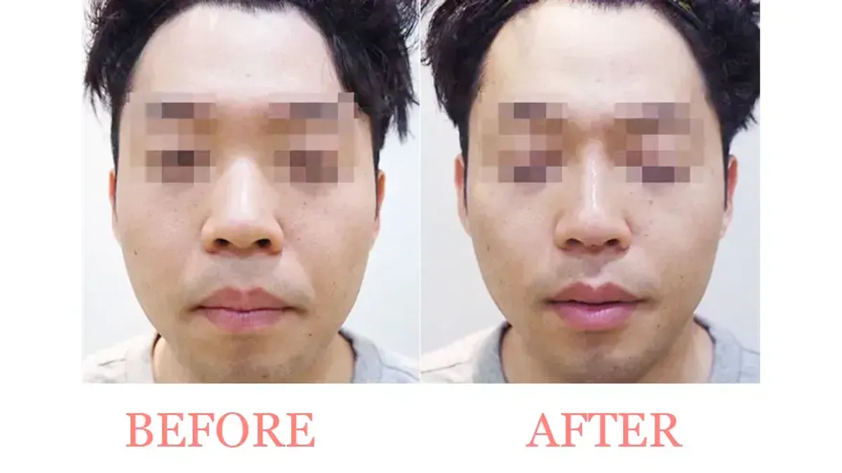 Nose Filler
