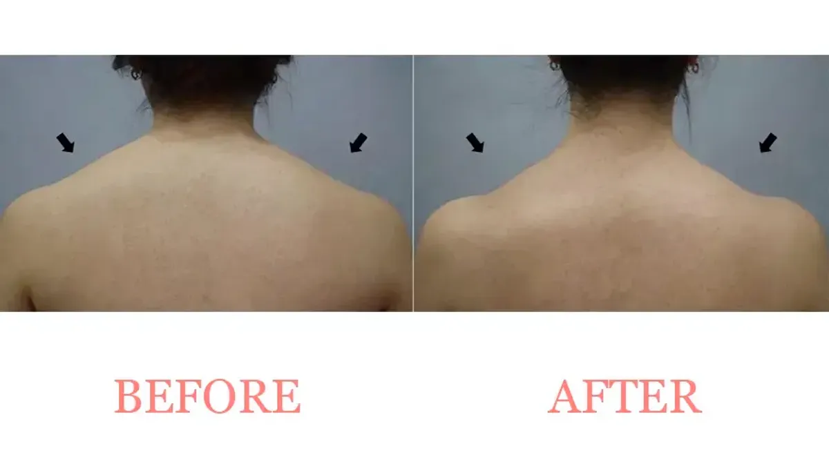 Trapezius Botox Treatment