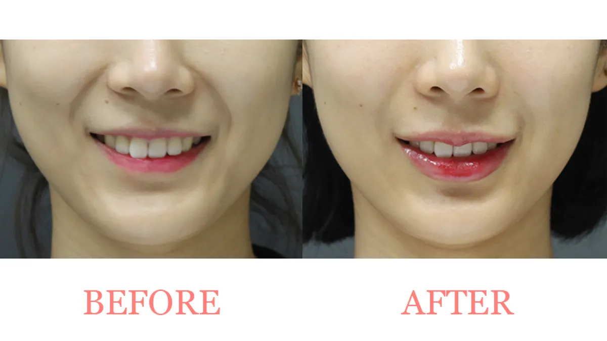Nasolabial Fold & Lip Filler