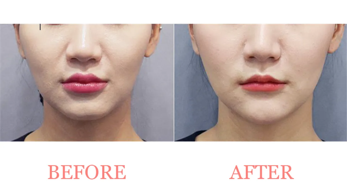 Chin Filler