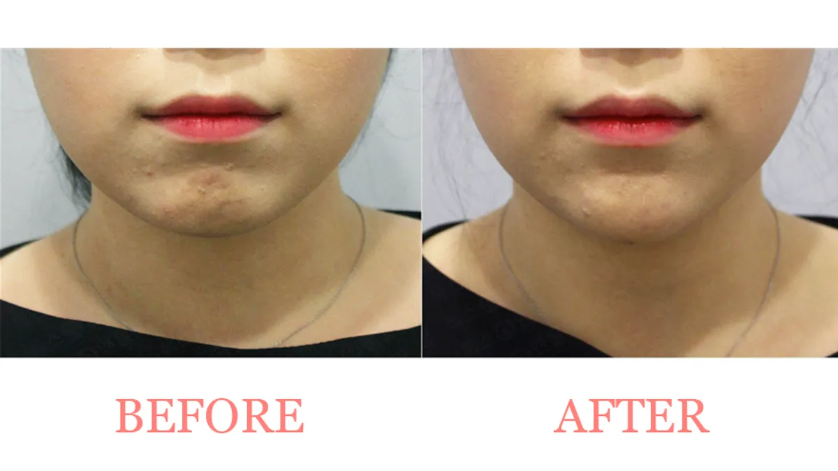 Chin Filler