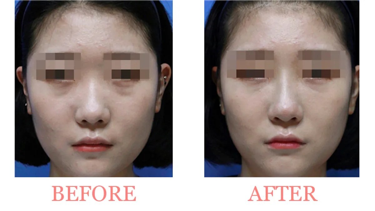 Under-Eye Filler Treatment