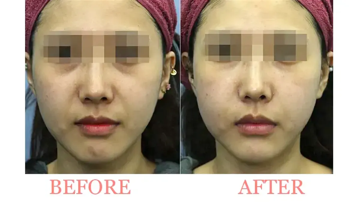 Under-Eye Filler