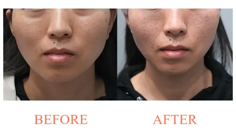 Filler: Under-Eye Area