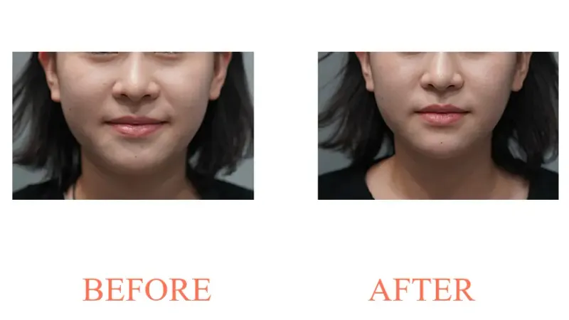 Filler: Chin Tip