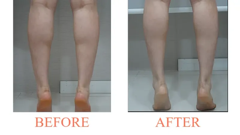 Calf Botox