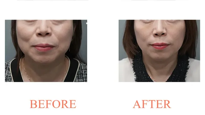 Juvelook Volume: Under-Eye Area