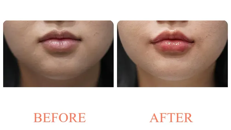 Filler: Lips