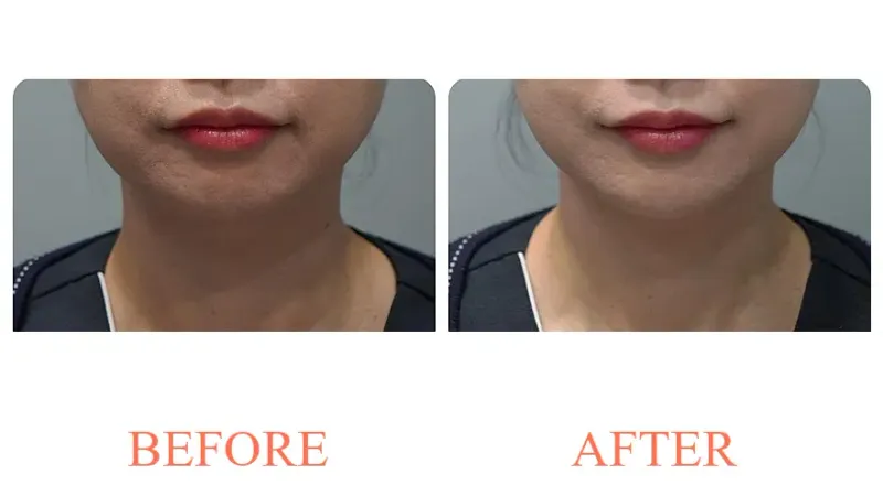 Filler: Chin Tip