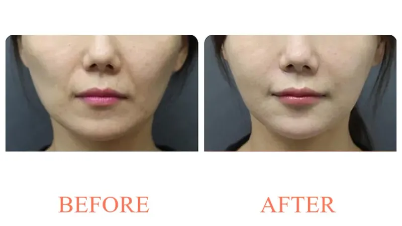 Filler: Nasolabial Folds + Lateral Cheeks + Chin Tip