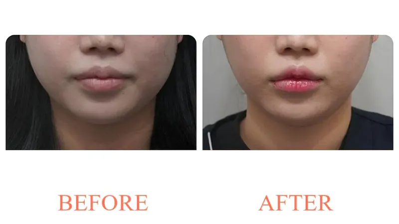 Ultherapy (500 Shots) + ONDA + Jaw Botox + Bellacholine