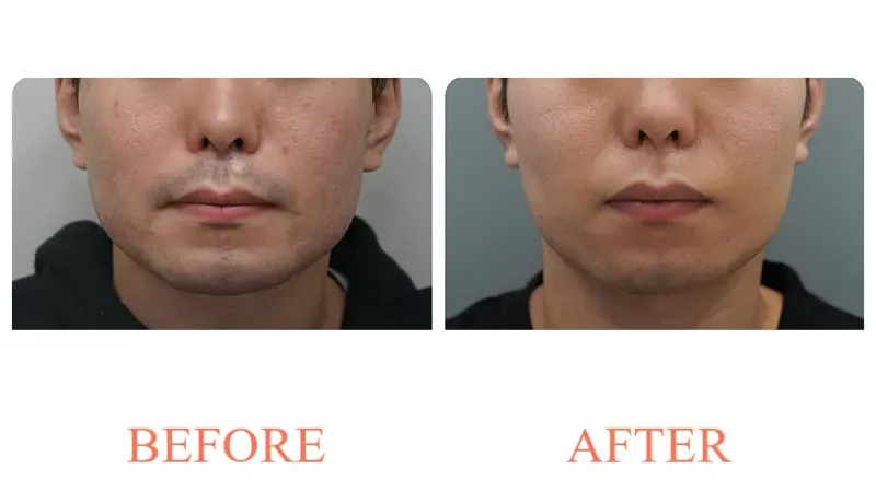 Potenza + Hair Removal