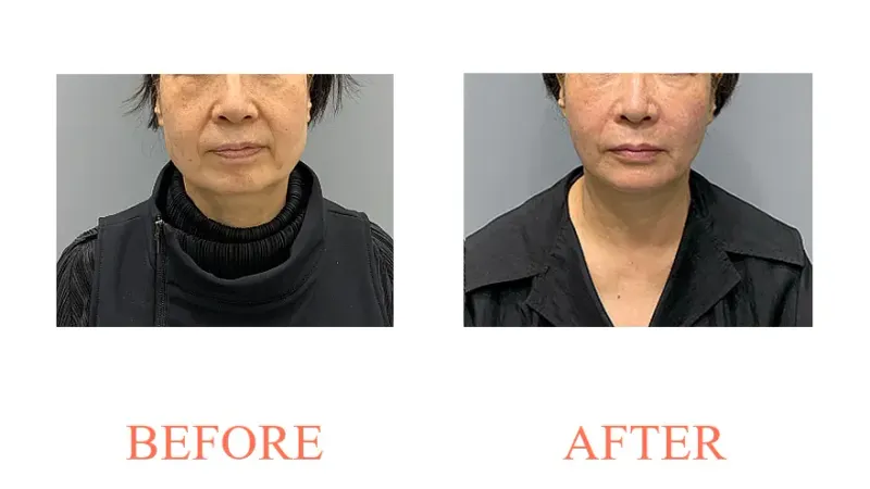 Ultherapy (600 Shots) + Titanium + Nasolabial Fold Filler