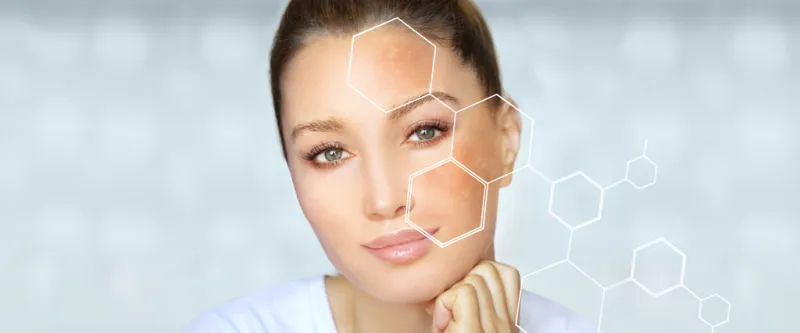Can Melasma Be Fully Cured With Injection Treatment?